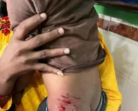 చిన్నారిపై వీధి కుక్క దాడి 